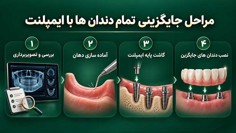 آیا می توان تمام دندان های از دست رفته را با ایمپلنت جایگزین کرد؟ تصویر 1