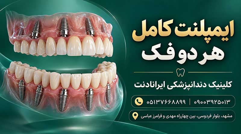 ایمپلنت کامل هر دو فک در کلینیک دندانپزشکی ایرانادنت مشهد